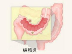 南宁治疗结肠炎哪家医院